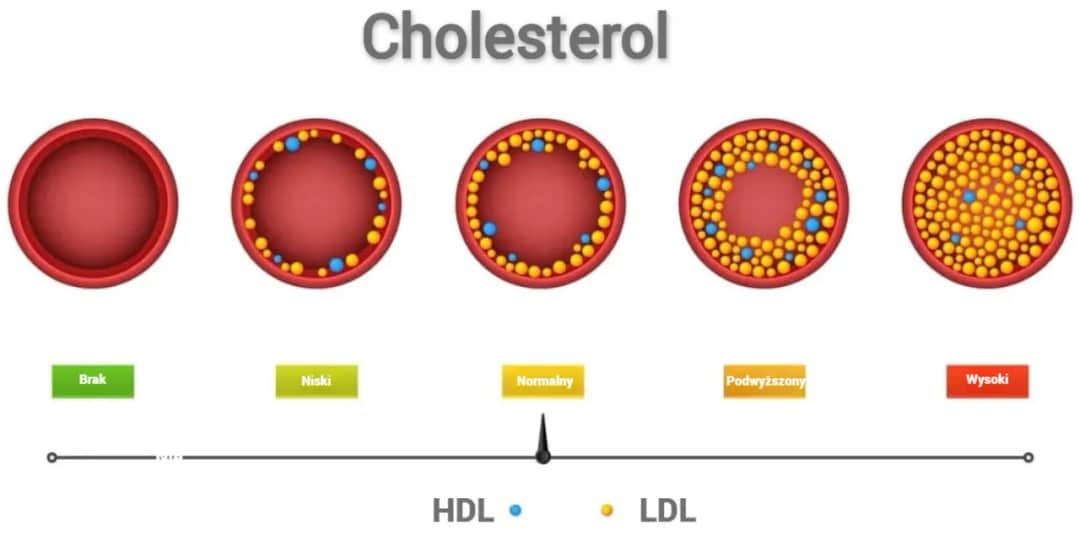 Prawidłowy cholesterol LDL: jakie wartości są niebezpieczne dla zdrowia?