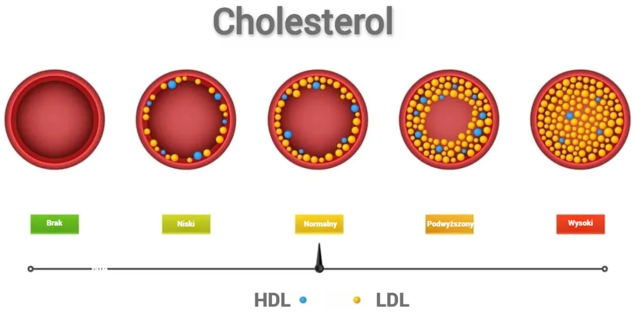 Prawidłowy cholesterol LDL: jakie wartości są niebezpieczne dla zdrowia?