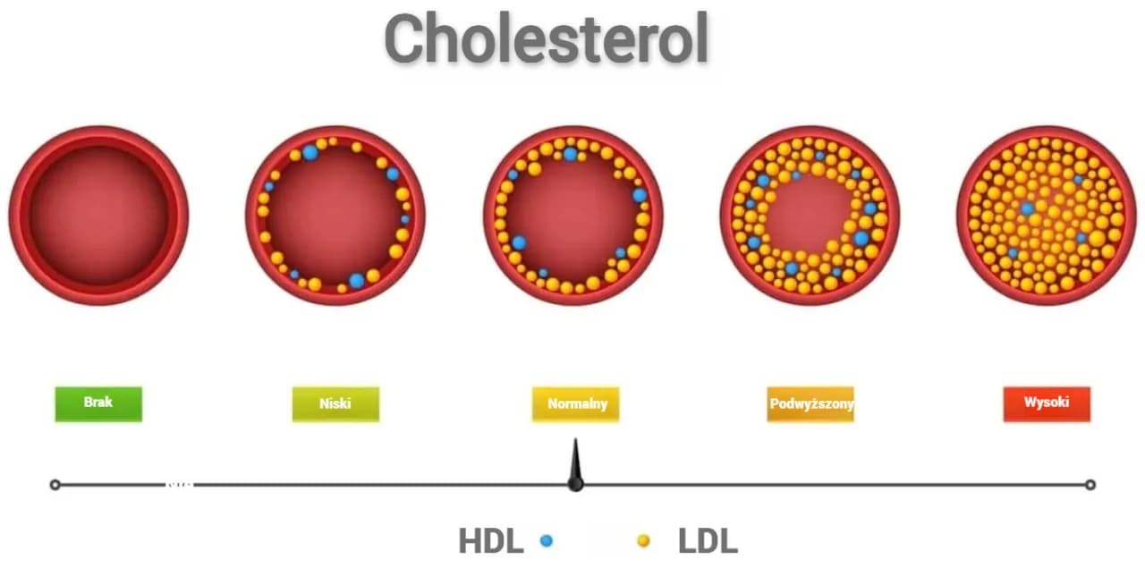 Prawidłowy cholesterol LDL: jakie wartości są niebezpieczne dla zdrowia?