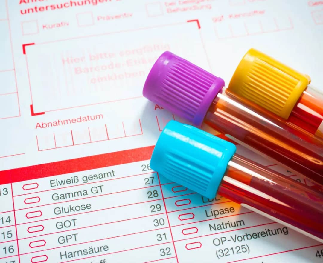 Jak obniżyć cholesterol przed badaniem i poprawić wyniki testu