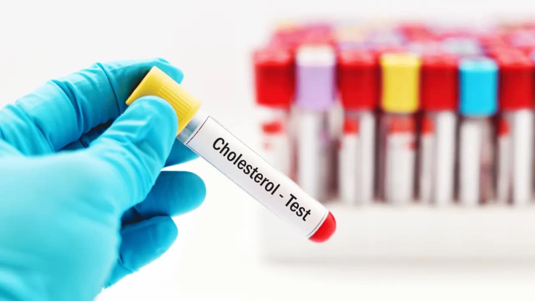 Cholesterol całkowity 250 – czy to dużo i jakie niesie ryzyko?